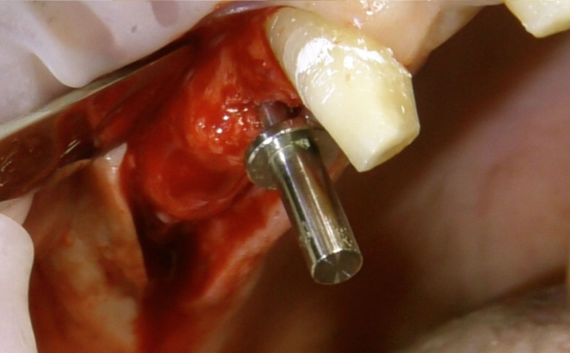 Fig. 6 Inserimento nel sito implantare del pin di parallelismo per la verifica dell’orientamento rispetto al moncone contiguo.