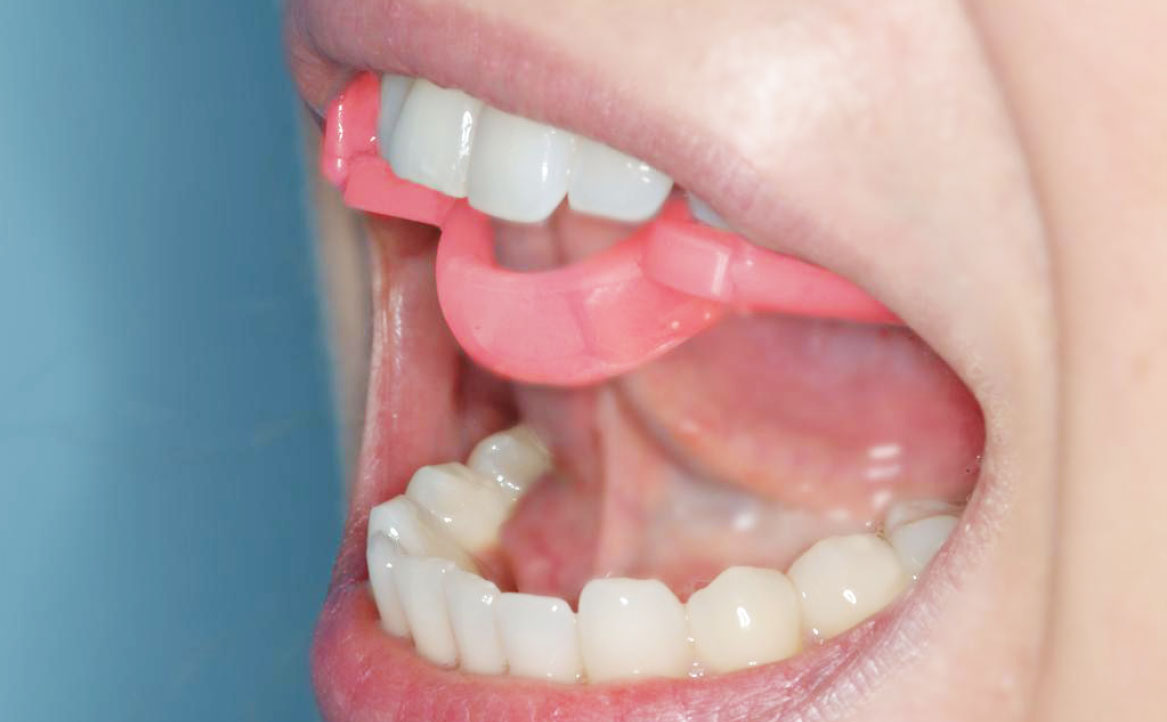 Fig. 1 Dettagli dell’inserimento e posizionamento della lingua allo spot mediante il bite anello linguale RI.P.A.RA. Il bite RI.P.A.RA. è un dispositivo di riposizionamento rieducativo funzionale che modifica la posizione e la postura della mandibola, dei condili, della lingua e quindi di tutto il sistema di vettori e di forze dei muscoli masticatori. Non è un semplice spessore che si inserisce tra i denti. Il paziente non deve portare il bite RI.P.A.RA solo in modo statico e passivo ma deve eseguire specifici esercizi in modo attivo con il bite in bocca, come descritto nel testo.