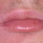 Fig. 2A Casi clinici di edema pronunciato localizzato alle labbra indotto dalla assunzione di FANS.