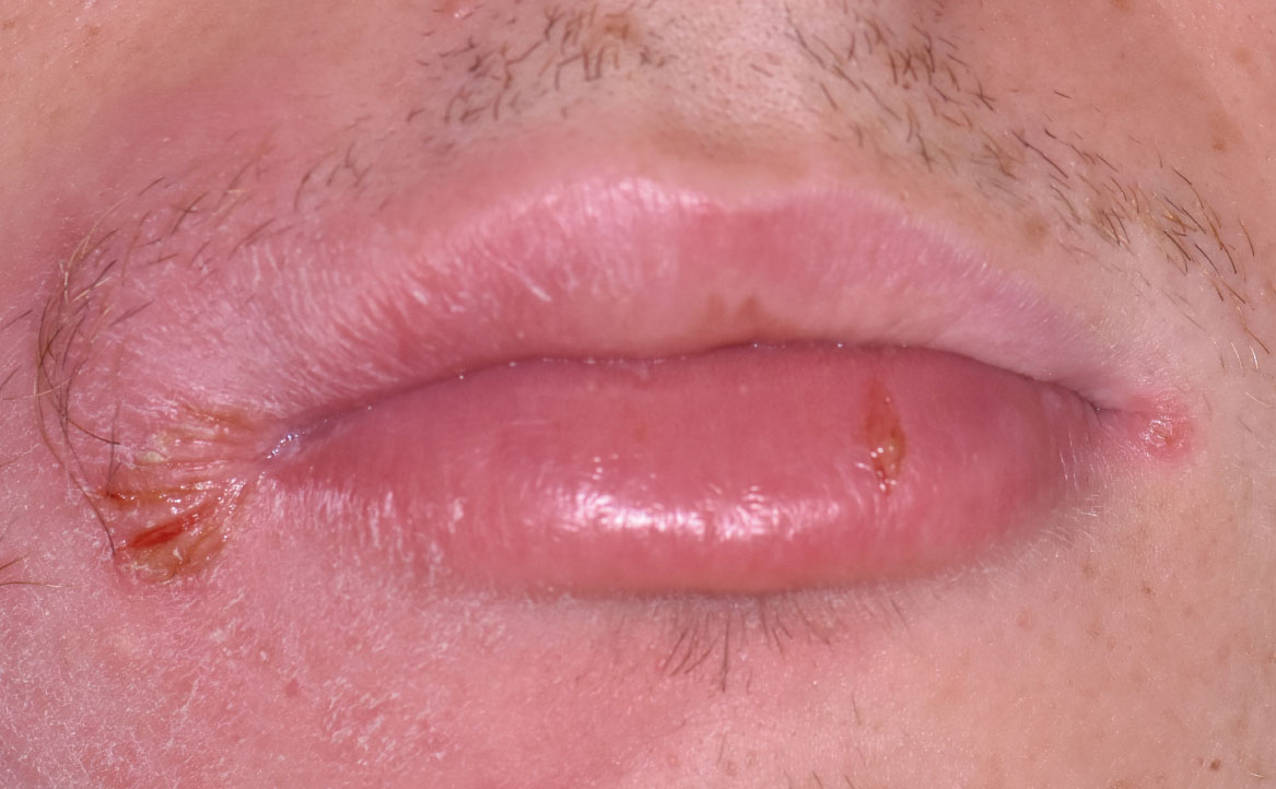 Fig. 2A Casi clinici di edema pronunciato localizzato alle labbra indotto dalla assunzione di FANS.