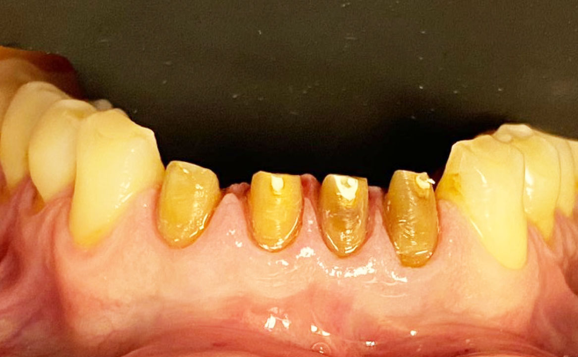 Fig. 6 Guarigione a 7 giorni.