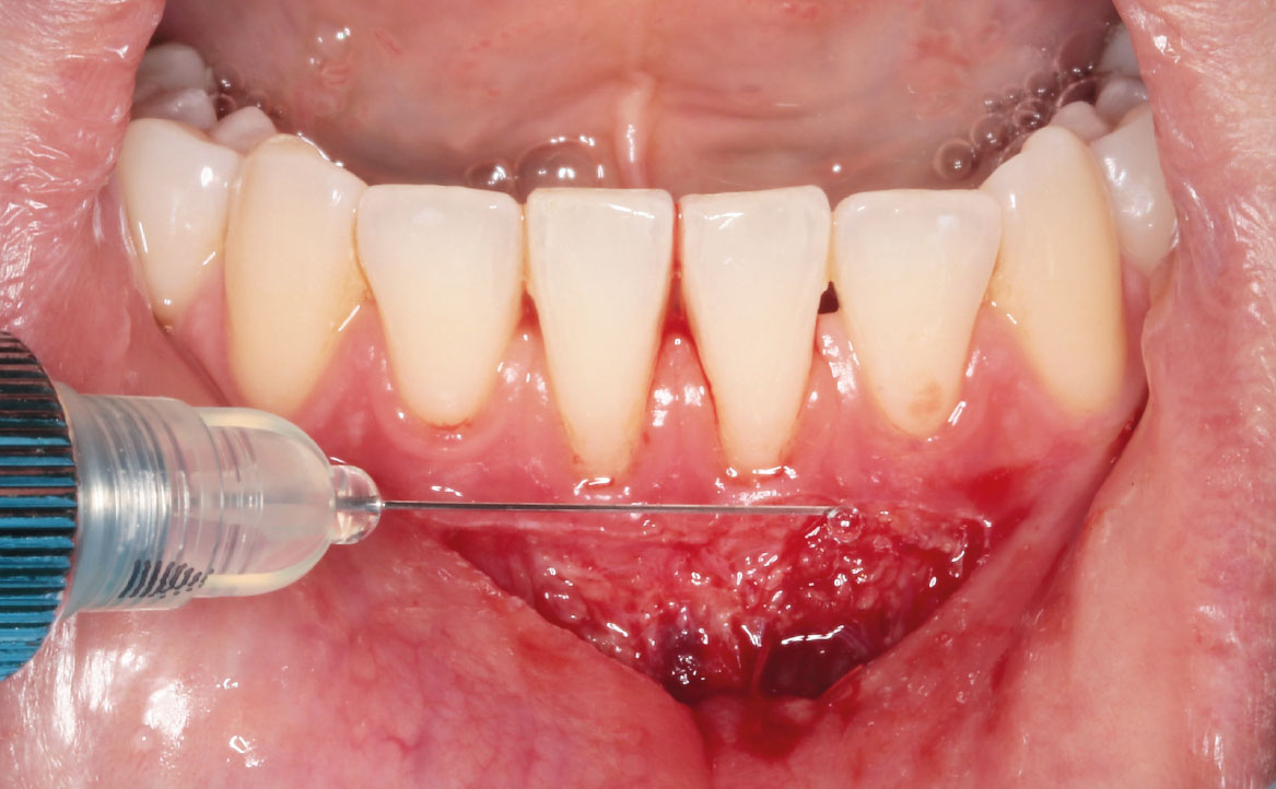 Fig. 7 Applicazione di un gel di acido ialuronico reticolato.