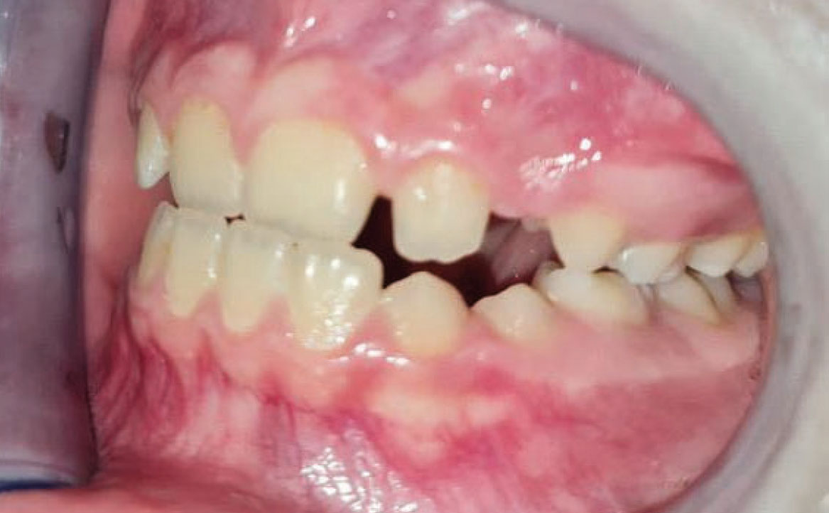 Fig. 4C Foto intraorale in massima intercuspidazione.
