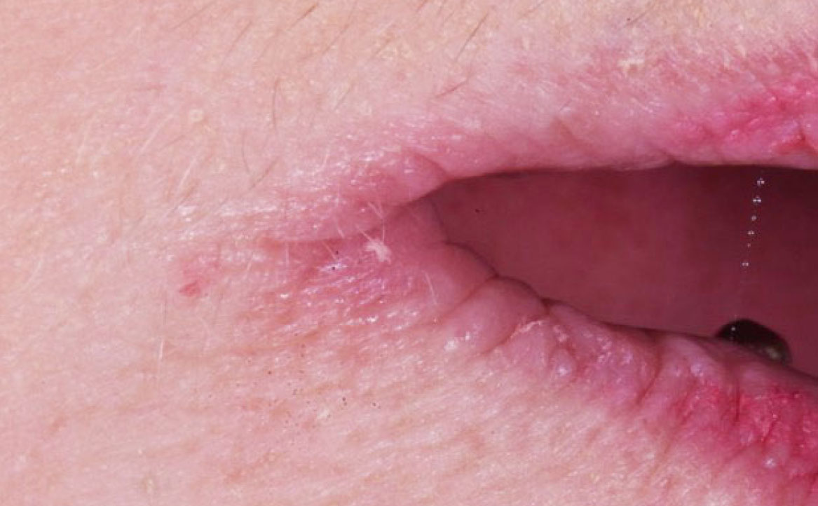 Fig. 1A Manifestazioni cliniche correlate a xerostomia in paziente che assume lisinopril (antipertensivo ACE -inibitore): cheilite angolare, depapillazione e atrofia della superficie linguale associati a lamentanze di secchezza della bocca, dolore agli angoli delle labbra e sensazione di bruciore diffuso.