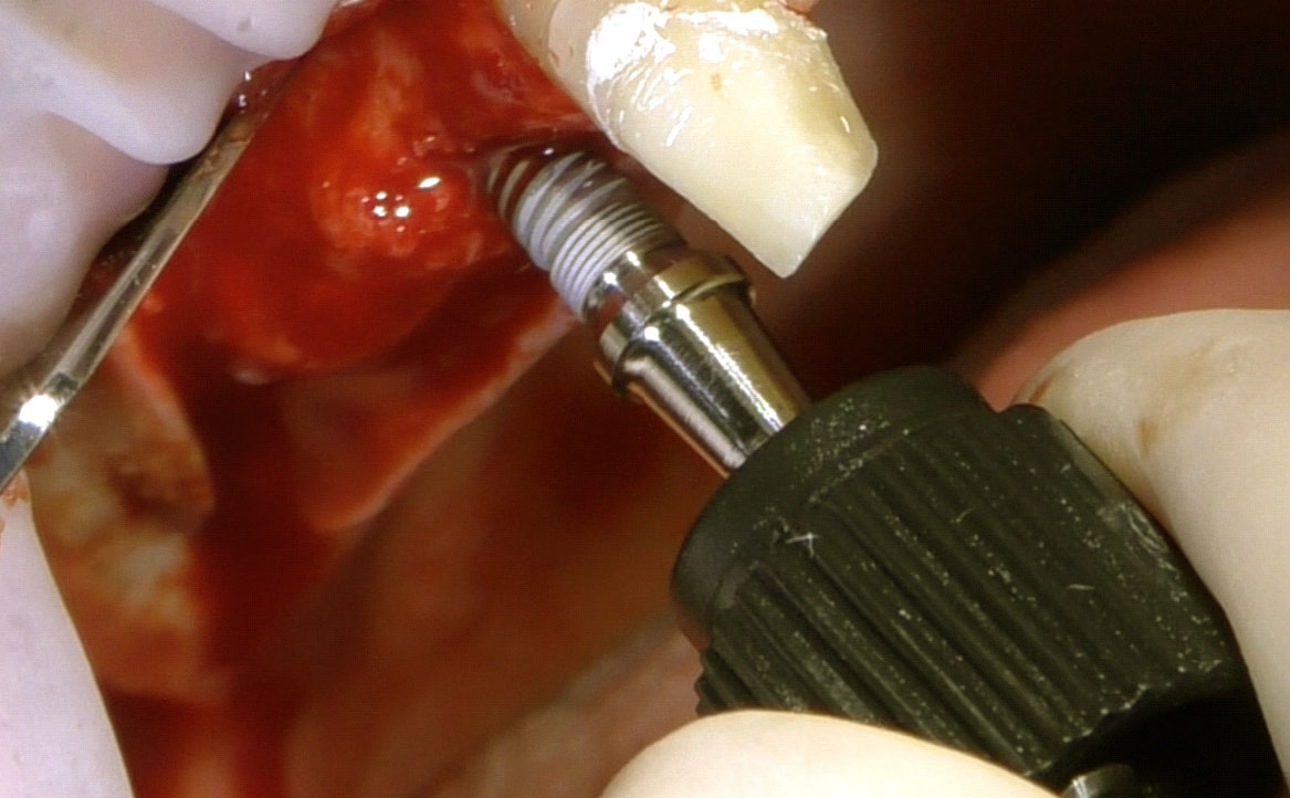 Fig. 7 Posizionamento del primo impianto in sede 1.4.