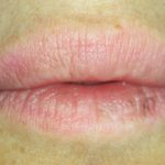 Fig. 2B Casi clinici di edema pronunciato localizzato alle labbra indotto dalla assunzione di FANS.