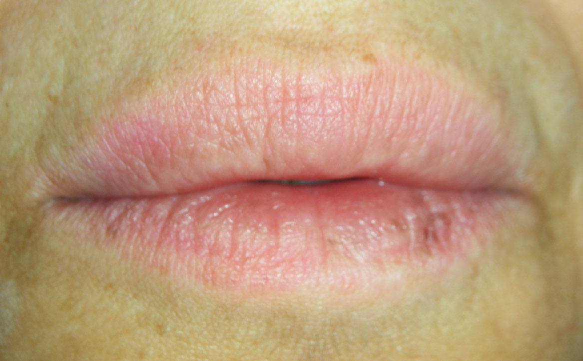 Fig. 2B Casi clinici di edema pronunciato localizzato alle labbra indotto dalla assunzione di FANS.