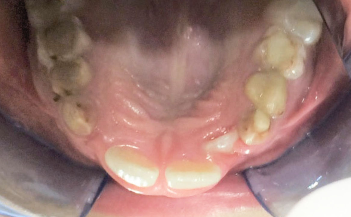 Fig. 3E Foto intraorale arcata superiore.