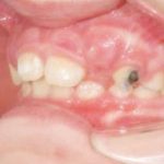 Fig. 7 Fotografia intra orali: laterale sinistra.