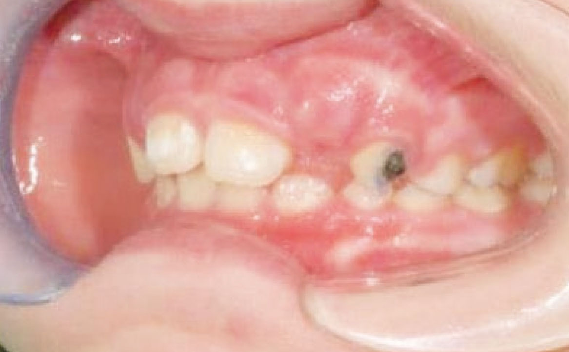 Fig. 7 Fotografia intra orali: laterale sinistra.