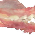 Fig. 5A Modello digitale occlusione dx e sx. Dall’esame clinico e dai modelli digitali si evidenzia una classe canina non valutabile e una classe molare I a destra e a sinistra.
