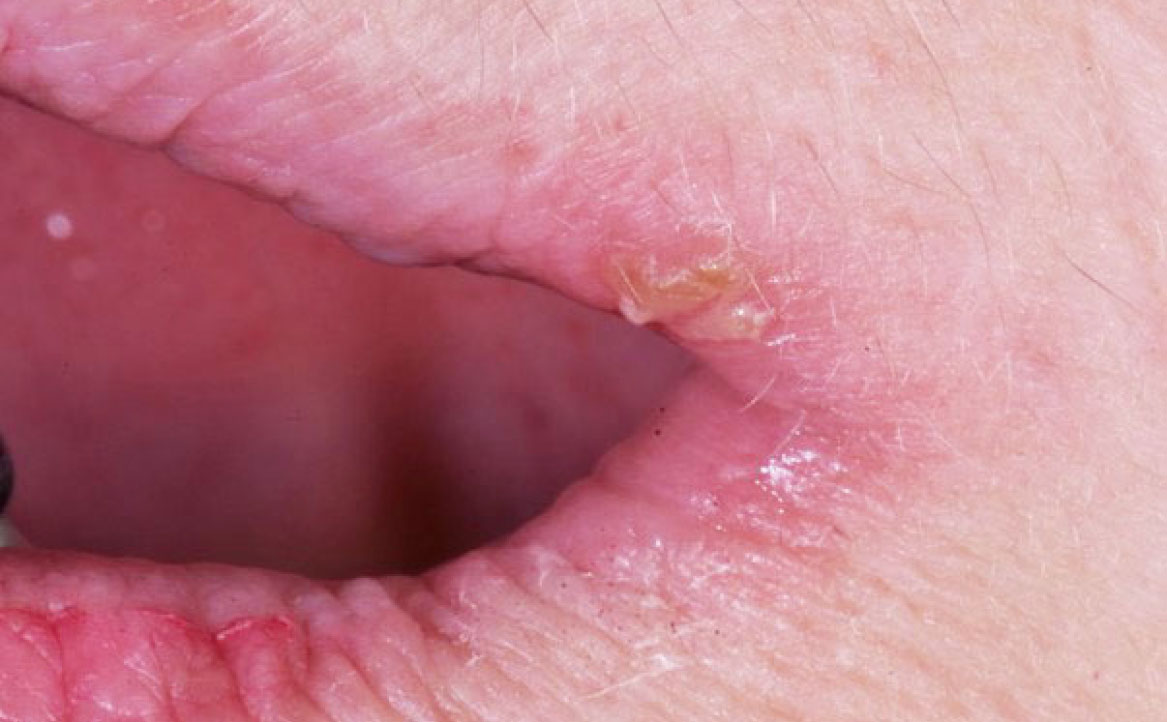 Fig. 1B Manifestazioni cliniche correlate a xerostomia in paziente che assume lisinopril (antipertensivo ACE -inibitore): cheilite angolare, depapillazione e atrofia della superficie linguale associati a lamentanze di secchezza della bocca, dolore agli angoli delle labbra e sensazione di bruciore diffuso.