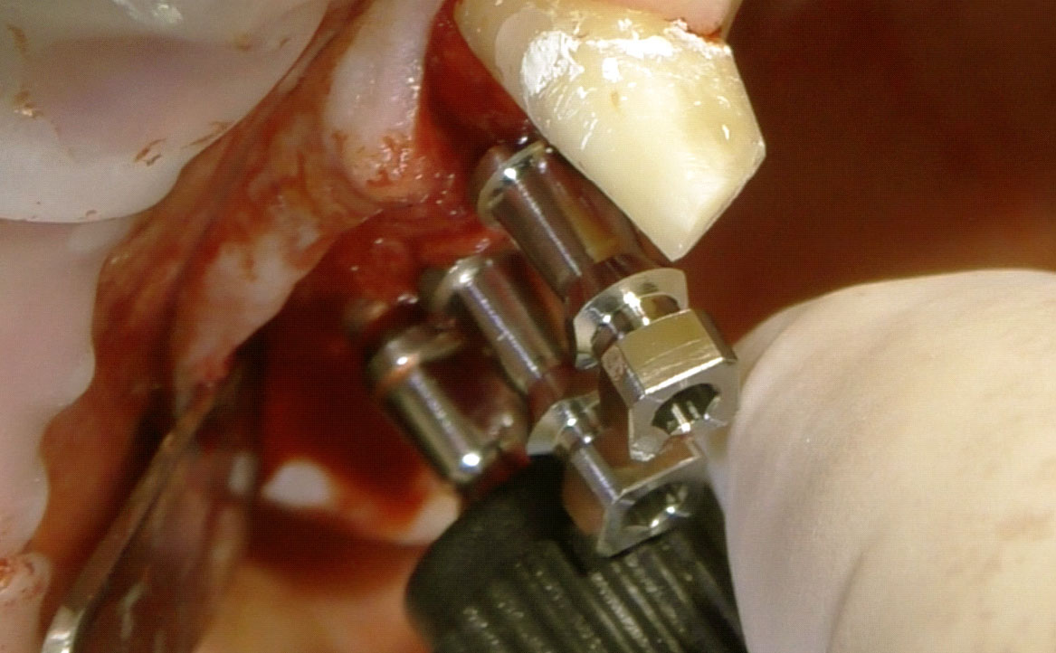 Fig. 8 Posizionamento sequenziale delle fixture in posizione 1.5 e 1.6.