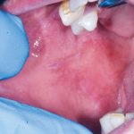 Fig. 3A Caso clinico di lesioni lichenoidi farmaco-indotte localizzata in modo asimmetrico a livello delle mucose geniene, dove è evidente lesione reticolare associate ad aree più eritematose.