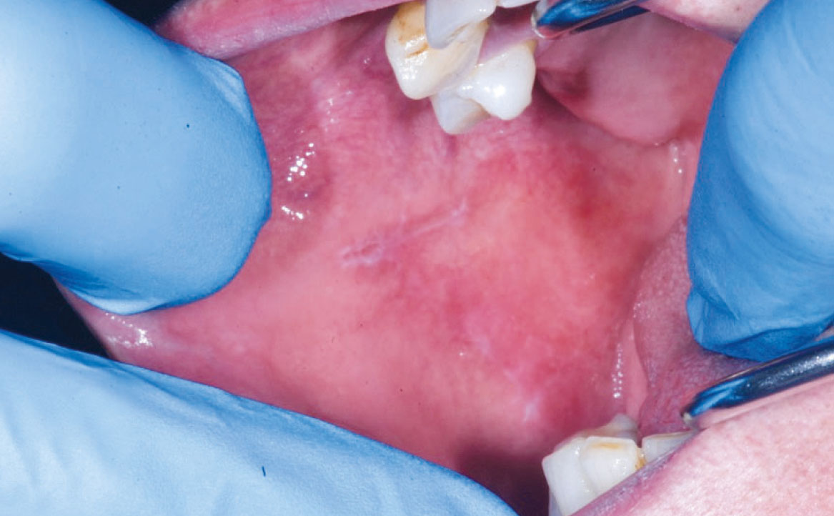 Fig. 3A Caso clinico di lesioni lichenoidi farmaco-indotte localizzata in modo asimmetrico a livello delle mucose geniene, dove è evidente lesione reticolare associate ad aree più eritematose.