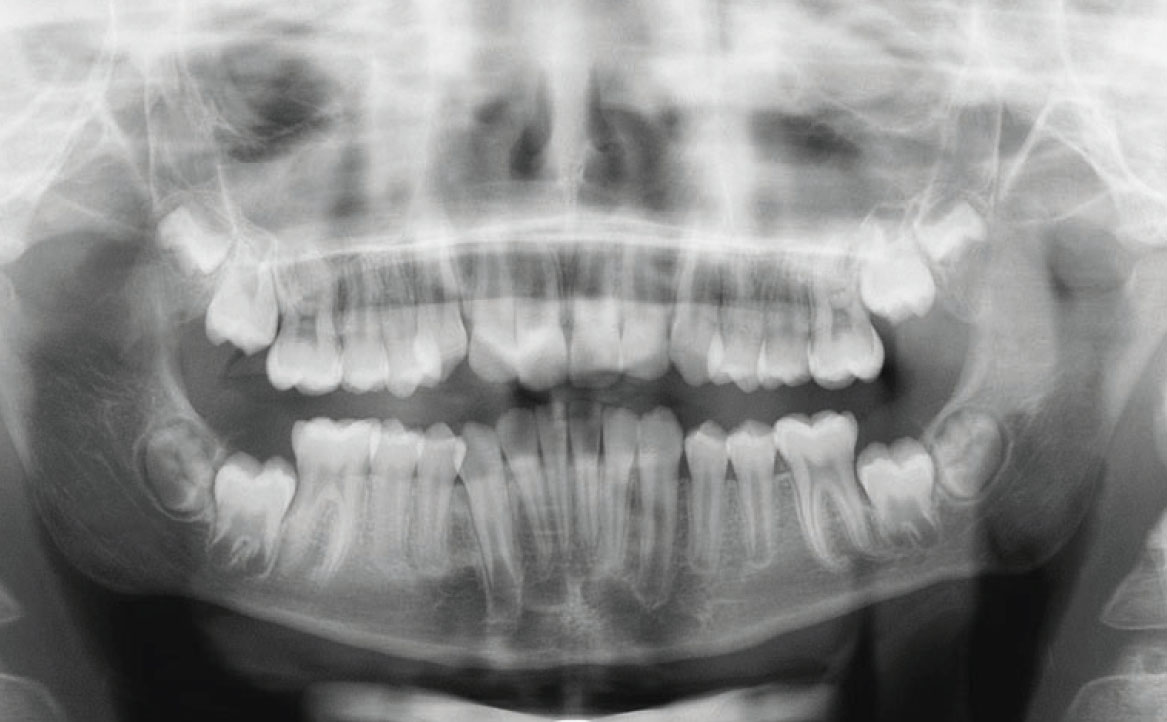 Fig. 4 Ortopantomografia.