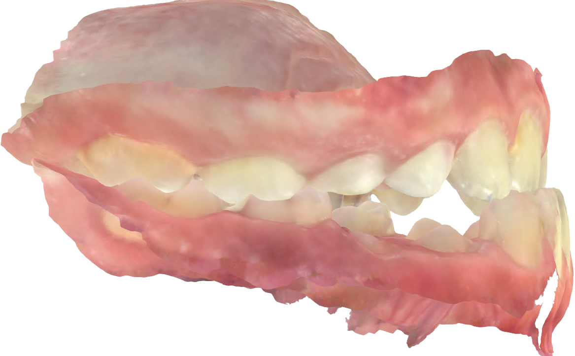 Fig. 5A Modello digitale occlusione dx e sx. Dall’esame clinico e dai modelli digitali si evidenzia una classe canina non valutabile e una classe molare I a destra e a sinistra.