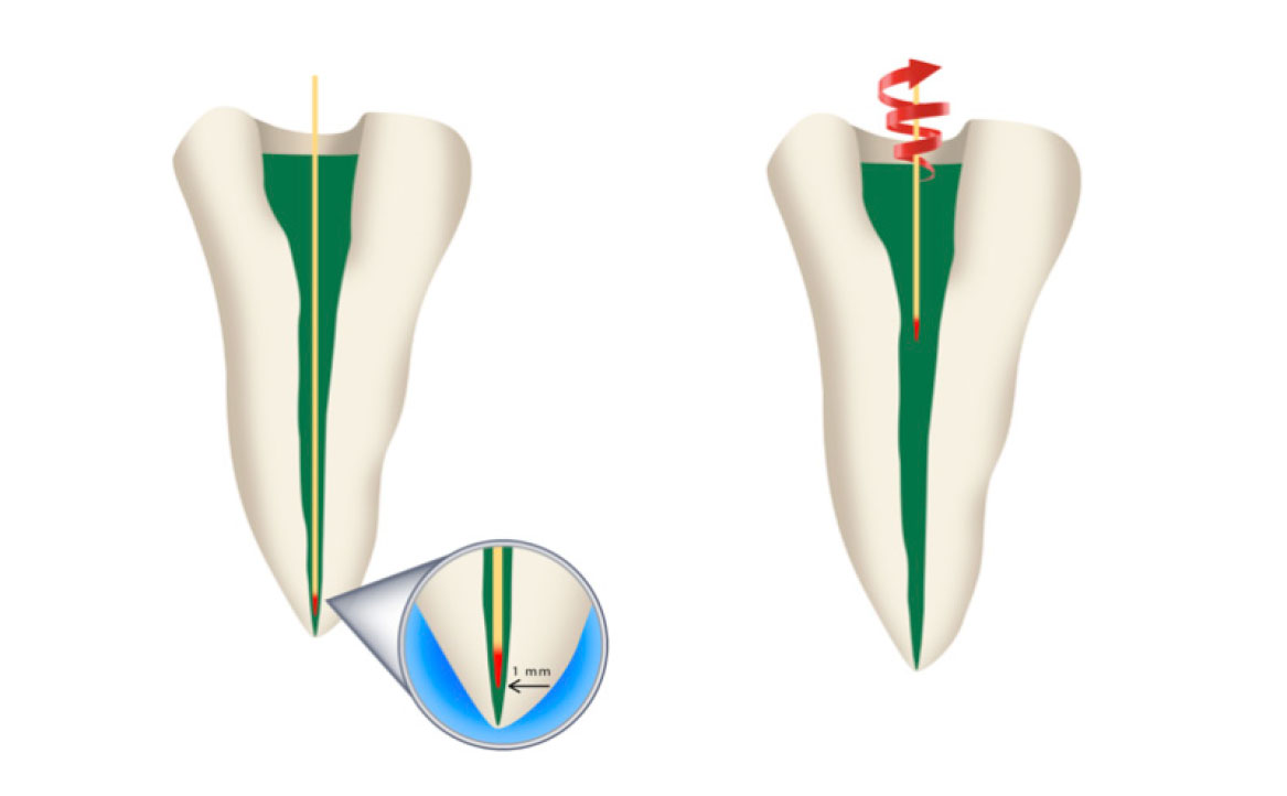 Fig. 5 aPDT, fotosensibilizzante ICG, attivato da fibra portata ad 1mm dall’apice ed estratta con movimento circolare.