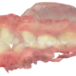 Fig. 5B Modello digitale occlusione dx e sx. Dall’esame clinico e dai modelli digitali si evidenzia una classe canina non valutabile e una classe molare I a destra e a sinistra.