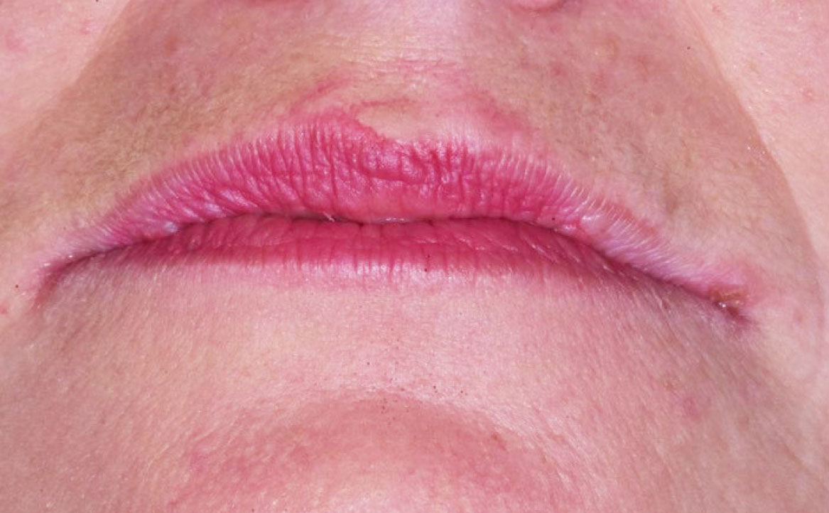 Fig. 1C Manifestazioni cliniche correlate a xerostomia in paziente che assume lisinopril (antipertensivo ACE -inibitore): cheilite angolare, depapillazione e atrofia della superficie linguale associati a lamentanze di secchezza della bocca, dolore agli angoli delle labbra e sensazione di bruciore diffuso.