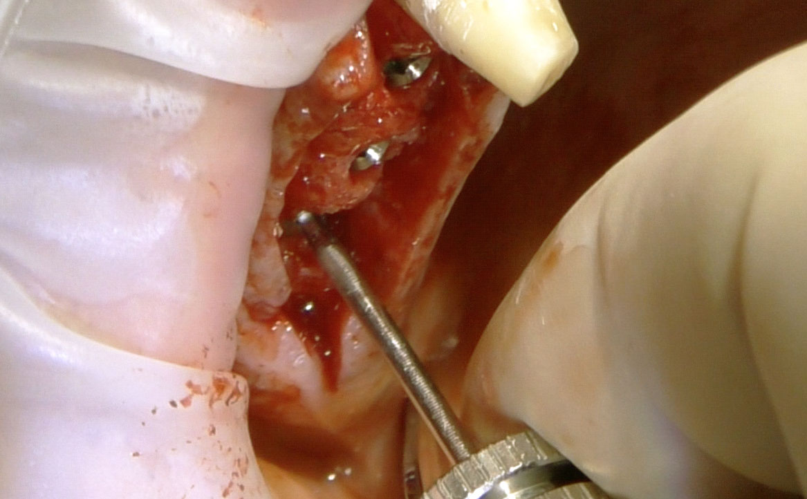 Fig. 9 Avvitamento delle viti tappo per guarigione sommersa.