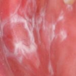 Fig. 3B Caso clinico di lesioni lichenoidi farmaco-indotte localizzata in modo asimmetrico a livello delle mucose geniene, dove è evidente lesione reticolare associate ad aree più eritematose.