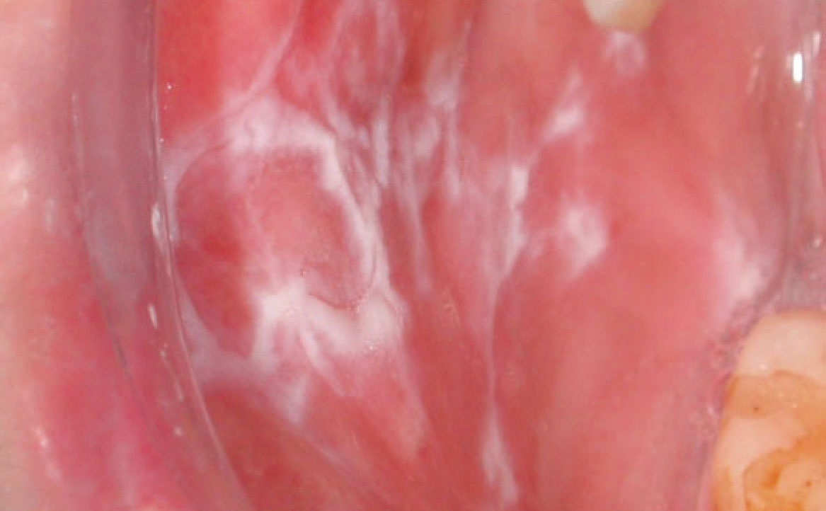 Fig. 3B Caso clinico di lesioni lichenoidi farmaco-indotte localizzata in modo asimmetrico a livello delle mucose geniene, dove è evidente lesione reticolare associate ad aree più eritematose.