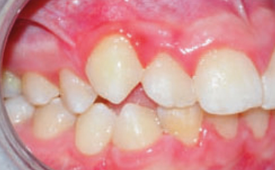 Fig. 5A Foto intraorale laterale di destra.