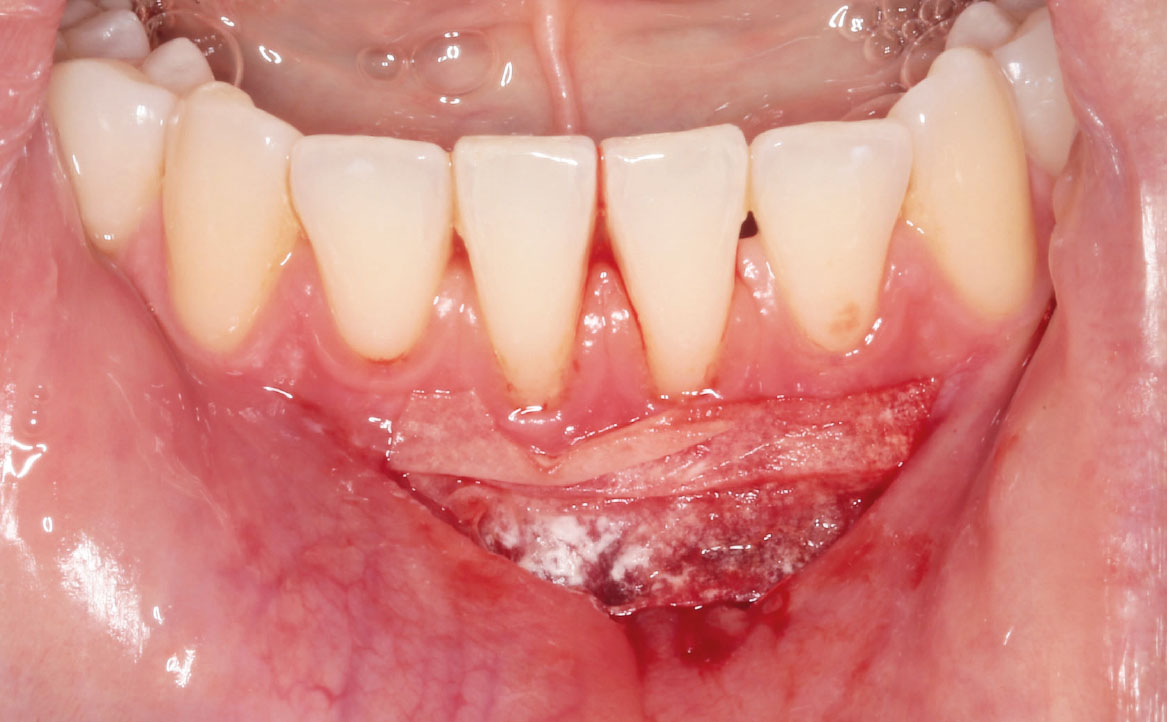 Fig. 9 Applicazione della membrana in pericardio suino precedentemente idratata in soluzione fisiologica.