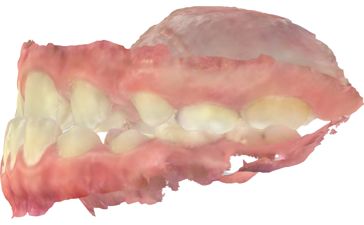 Fig. 5B Modello digitale occlusione dx e sx. Dall’esame clinico e dai modelli digitali si evidenzia una classe canina non valutabile e una classe molare I a destra e a sinistra.