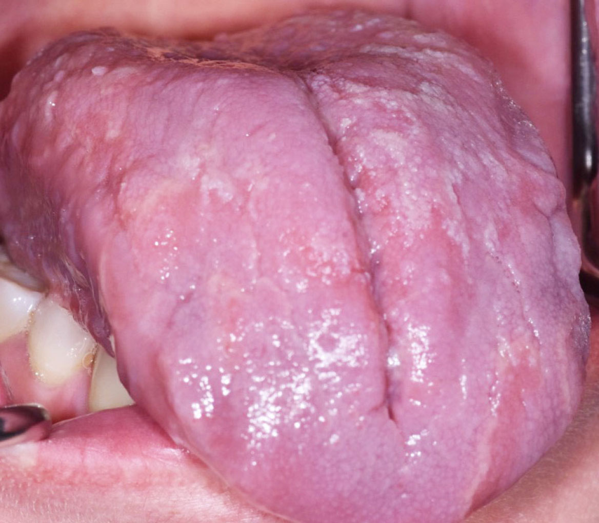 Fig. 1D Manifestazioni cliniche correlate a xerostomia in paziente che assume lisinopril (antipertensivo ACE -inibitore): cheilite angolare, depapillazione e atrofia della superficie linguale associati a lamentanze di secchezza della bocca, dolore agli angoli delle labbra e sensazione di bruciore diffuso.