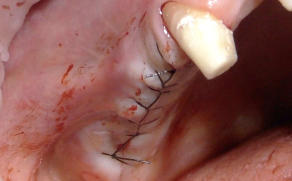 Fig. 10 Riposizionamento del lembo e suture.