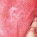 Fig. 3C Caso clinico di lesioni lichenoidi farmaco-indotte localizzata in modo asimmetrico a livello delle mucose geniene, dove è evidente lesione reticolare associate ad aree più eritematose.