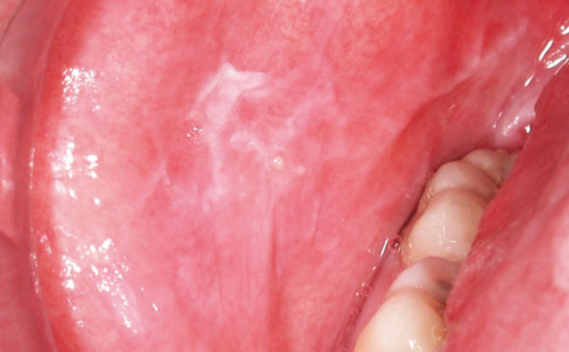 Fig. 3C Caso clinico di lesioni lichenoidi farmaco-indotte localizzata in modo asimmetrico a livello delle mucose geniene, dove è evidente lesione reticolare associate ad aree più eritematose.