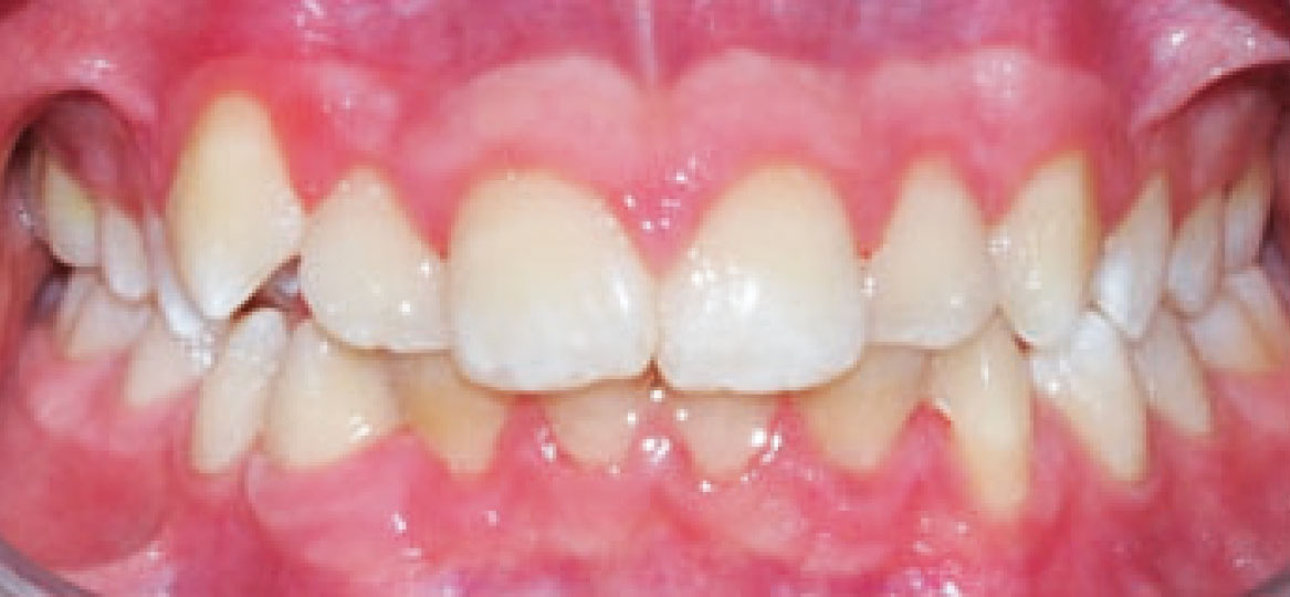 Fig. 5B Foto intraorale frontale.