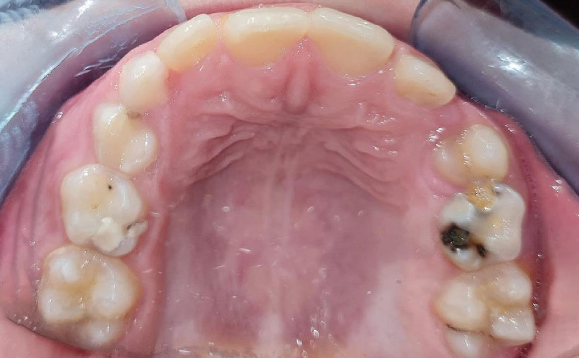 Fig. 6A Foto dell'arcata superiore.