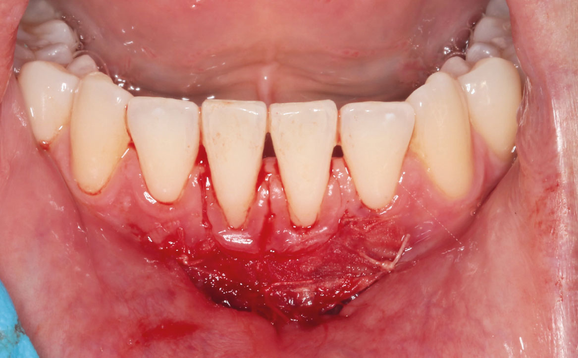 Fig. 10 Applicazione di punti di sutura per fissare la membrana al bordo del sito chirurgico.