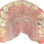 Fig. 6B Modello digitale dell’arcata superiore.