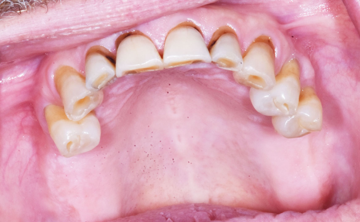 Fig. 2A Manifestazioni cliniche correlate a xerostomia che interessano i tessuti dentari in pazienti che assumono antidepressivi: evidenti lesioni erosive diffuse e carie a livello cervicale. L'accumulo significativo di placca e tartaro è visibile e aggravato dall’iposalivazione cronica.