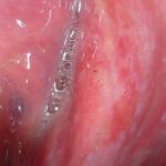 Fig. 4A Caso clinico di lesioni lupus-like caratterizzate da aeree eritematose erosive su mucose geniene, alveolari e gengivali associate a papule e fini reticoli periferici asimmetrici.