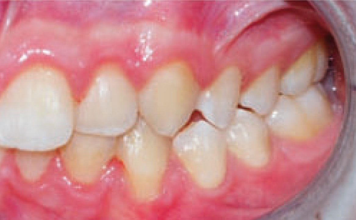 Fig. 5C Foto intraorale laterale di sinistra.