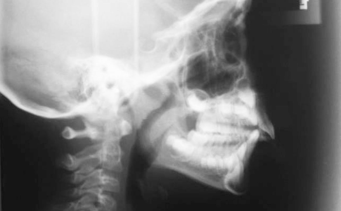 Fig. 11 Teleradiografia latero-laterale.