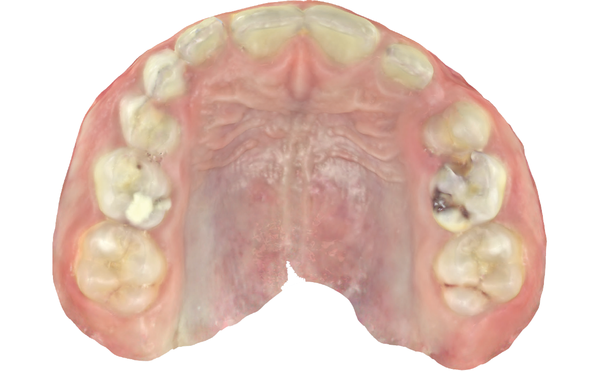 Fig. 6B Modello digitale dell'arcata superiore.