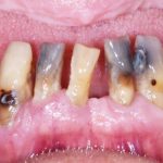 Fig. 2B Manifestazioni cliniche correlate a xerostomia che interessano i tessuti dentari in pazienti che assumono antidepressivi: evidenti lesioni erosive diffuse e carie a livello cervicale. L’accumulo significativo di placca e tartaro è visibile e aggravato dall’iposalivazione cronica.