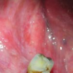 Fig. 4B Caso clinico di lesioni lupus-like caratterizzate da aeree eritematose erosive su mucose geniene, alveolari e gengivali associate a papule e fini reticoli periferici asimmetrici.