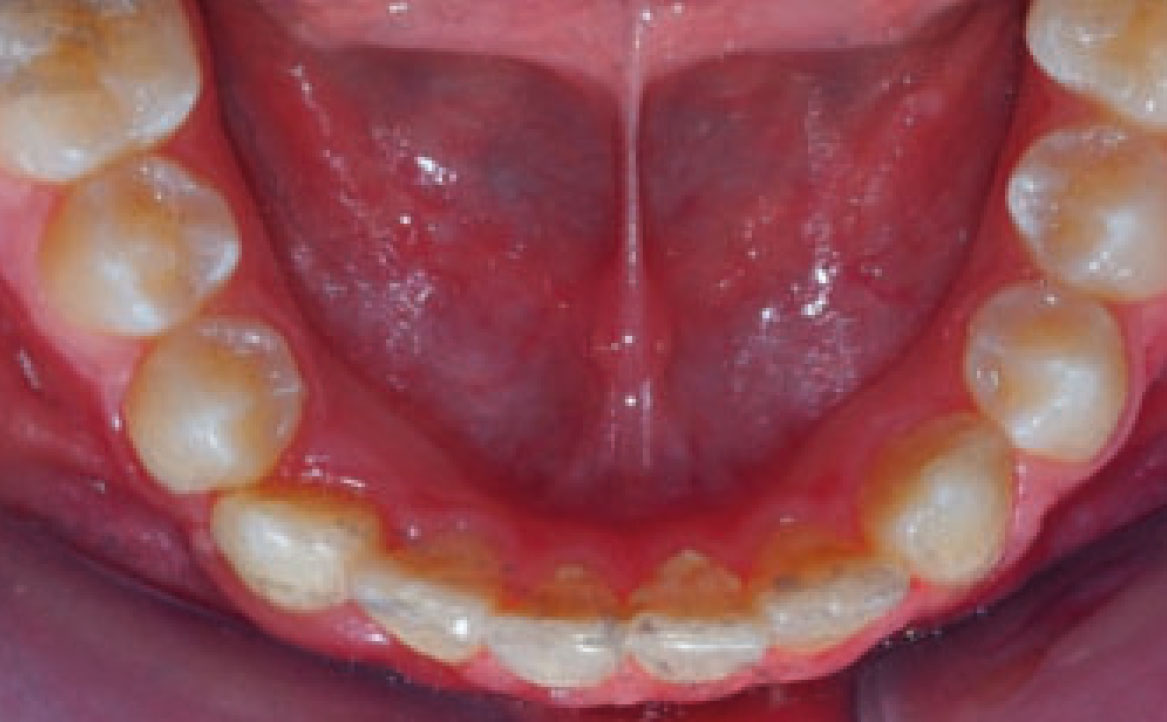 Fig. 5D Foto intraorale arcata inferiore.