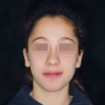 Fig. 12 Fotografia extra orale in fase intermedia di trattamento.