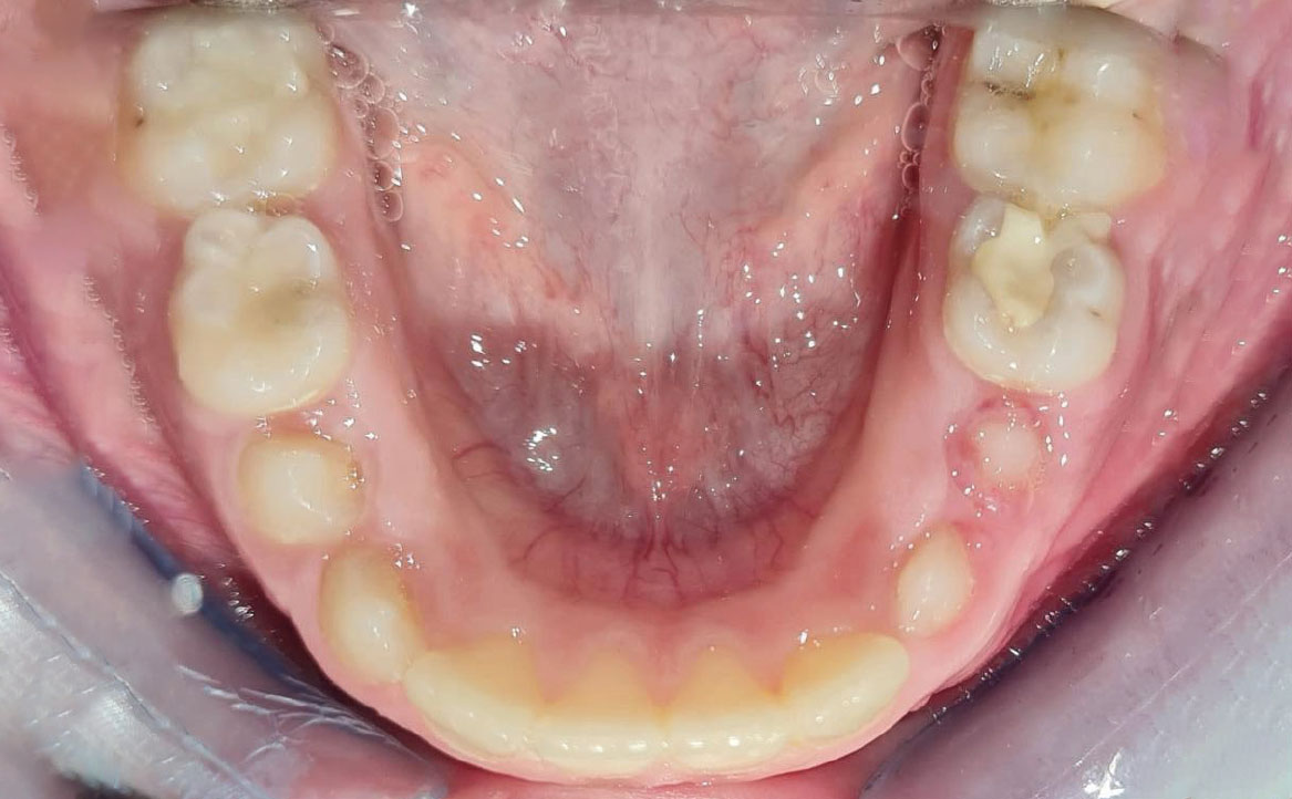 Fig. 7A Foto dell'arcata inferiore.
