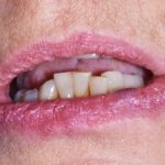 Fig. 3A Manifestazioni cliniche correlate a scialorrea in paziente che assumono clozapina (antipsicotico): cheilite angolare, dermatiti periorali.