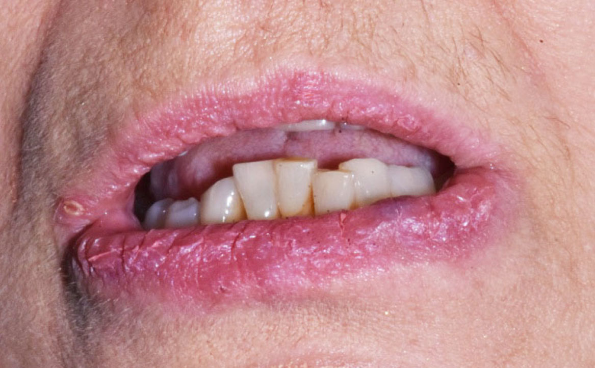 Fig. 3A Manifestazioni cliniche correlate a scialorrea in paziente che assumono clozapina (antipsicotico): cheilite angolare, dermatiti periorali.